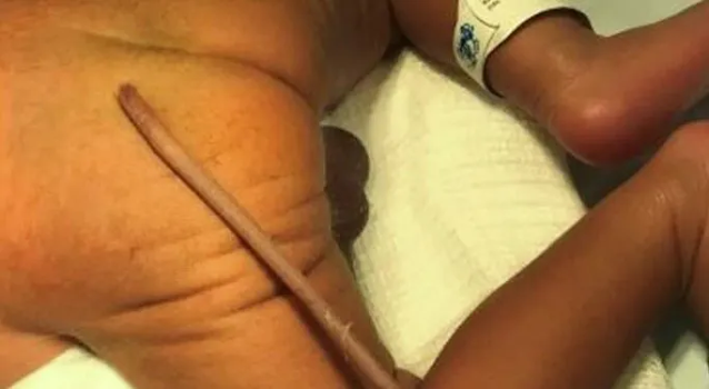 Απίστευτο – Μωρό γεννήθηκε πρόωρα με… ουρά 12 εκατοστών!