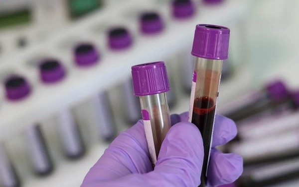 ΑΝΗΣΥΧΙΑ ΠΡΟΚΑΛΕΙ Η ΑΝΙΧΝΕΥΣΗ ΜΙΚΡΟΠΛΑΣΤΙΚΩΝ ΣΤΟ ΑΝΘΡΩΠΙΝΟ ΑΙΜΑ