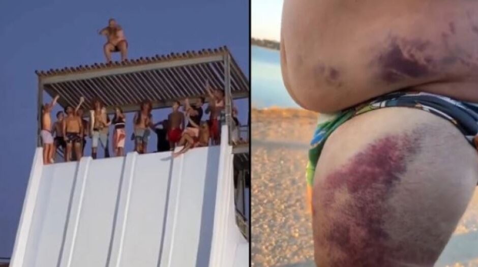 Κι όμως πλήρωσε το άλμα «θανάτου» από τη νεροτσουλήθρα – Το κορμί του έγινε μωβ από τις μελανιές