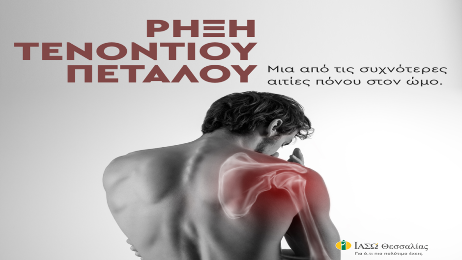 Ρήξη τενοντίου πετάλου: Μια από τις συχνότερες αιτίες πόνου στον ώμο