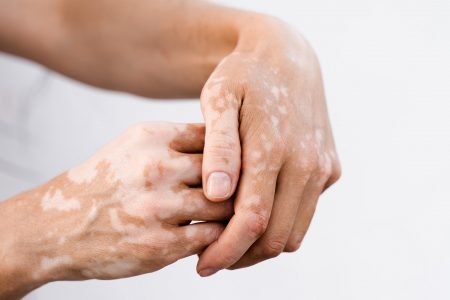 ΕΧΕΙΣ ΛΕΥΚΗ; ΜΑΘΕ (ΚΑΙ) ΤΑ ΚΑΛΑ ΝΕΑ