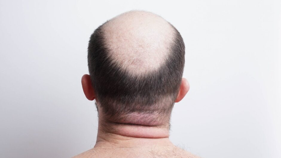 Έρχεται το εμβόλιο για τη φαλάκρα