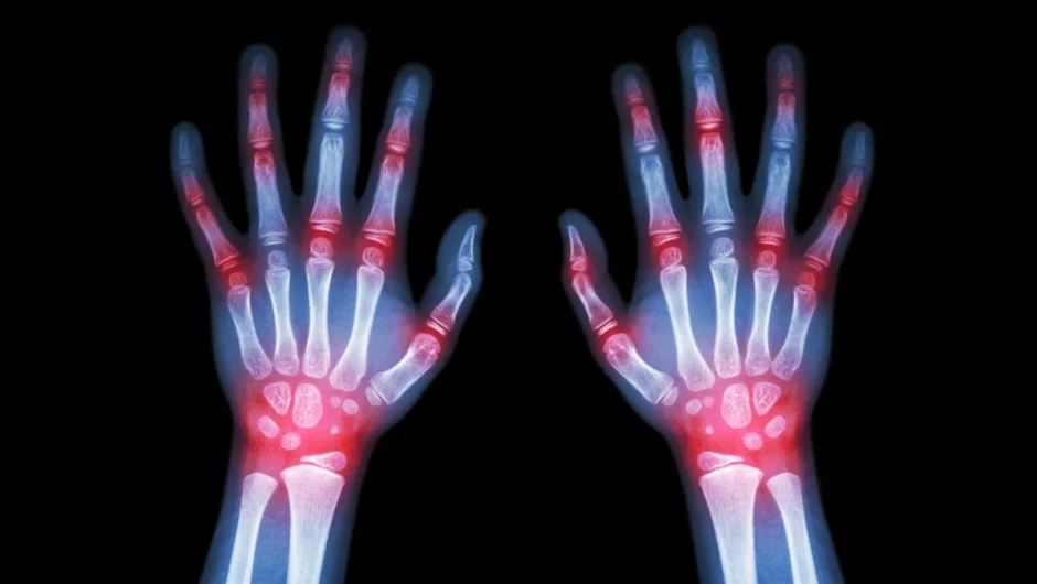 Ρευματοειδής αρθρίτιδα: Το φάρμακο που την προλαμβάνει