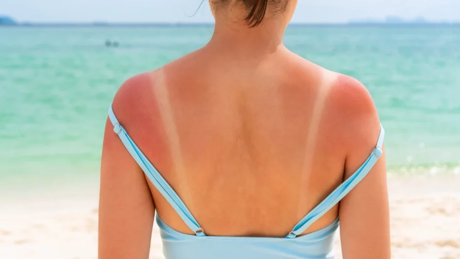 Τι να βάλετε σε ένα ηλιακό έγκαυμα και τι να μην βάλετε