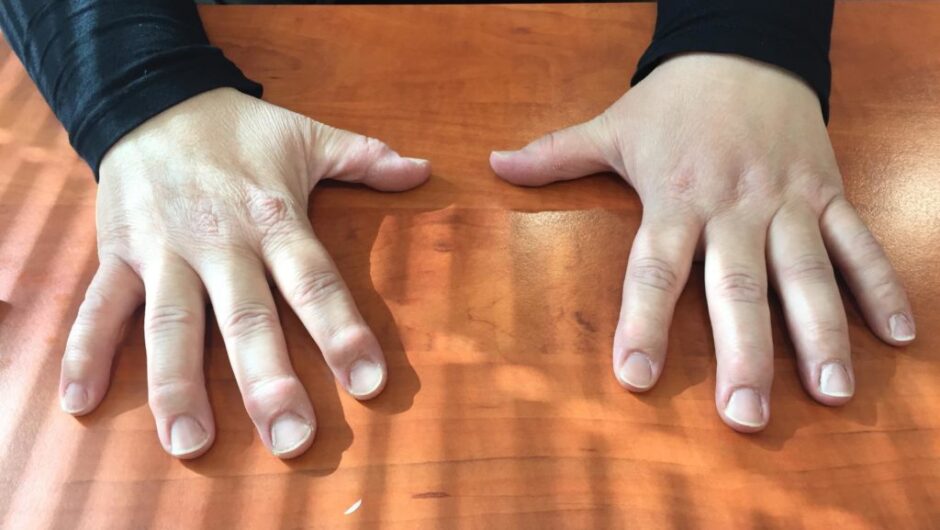 Αρθρίτιδα: Η Νο1 τροφή που βοηθά στην ανακούφιση από τον πόνο, σύμφωνα με ειδικούς