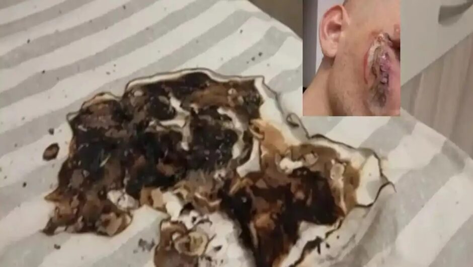 «Η μπαταρία πέταξε υγρά στο πρόσωπό μου, ήταν λες και μου έριξαν οξύ», λέει ο τραυματίας από έκρηξη κινητού