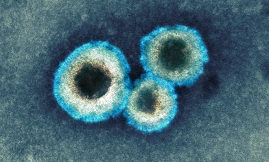 Μεταπνευμονοϊός – Βασιλακόπουλος: Αυτή την στιγμή κινδυνεύουμε περισσότερο από την γρίπη κι όχι από τον HMPV