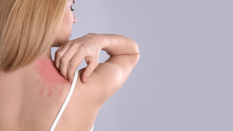 Εξάρσεις Εκζέματος: Πότε φταίνε οι ορμόνες;