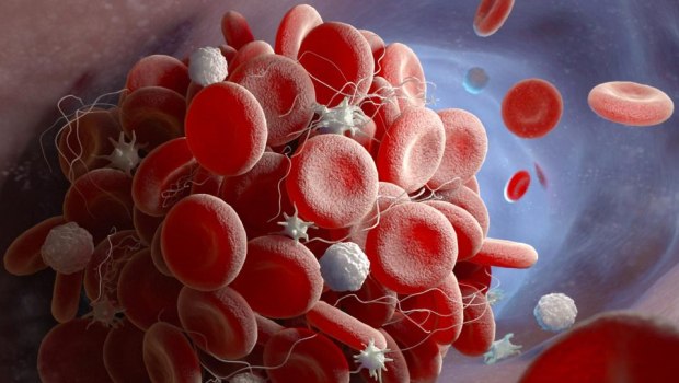 Θρόμβωση: Σιωπηλή απειλή που μπορεί να προληφθεί