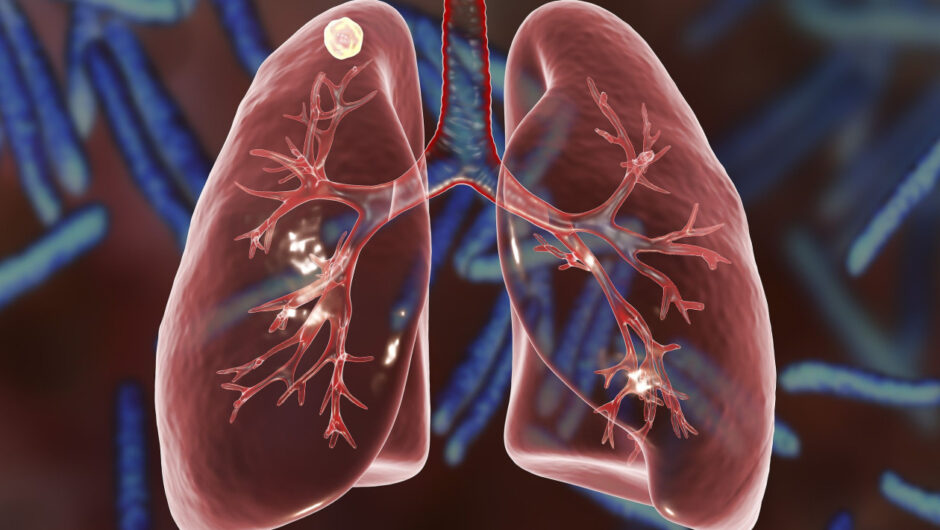 Φυματίωση: 440 κρούσματα στην Ελλάδα σε ένα χρόνο – Παραμένει η πιο θανατηφόρα λοίμωξη παγκοσμίως